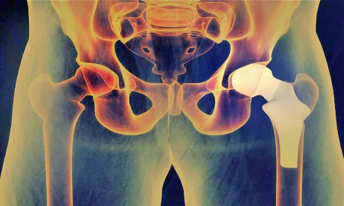 Hip Replacement