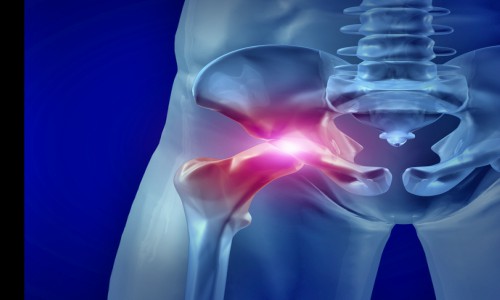Dislocated Hip Lawyer | Testa Law Group
