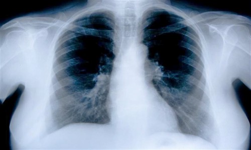 Lung Injury Lawyer